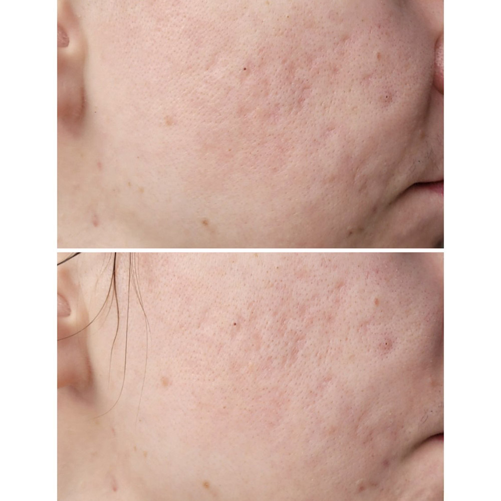 ژل شستشوی صورت ضد لک و جوش سراوی CeraVe Blemish Control Cleanser